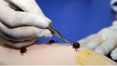 صورة كيفه / تأكيد حالة اصابة بحمى القرم الكونكو واشتباه في اخرى