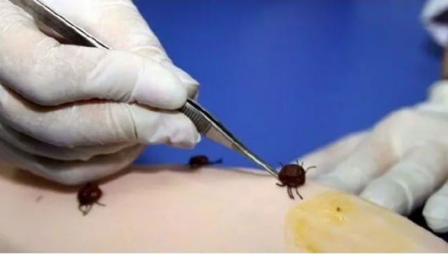 صورة كيفه / تأكيد حالة اصابة بحمى القرم الكونكو واشتباه في اخرى