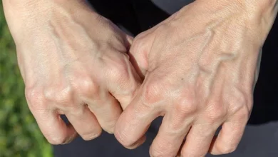 صورة لماذا تظهر عروق بعض الناس من الجلد وتختفي عند آخرين؟