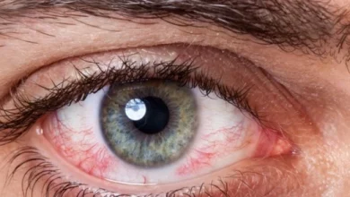 صورة احمرار العين يشير إلى عدة مشكلات صحية .. تعرف عليها